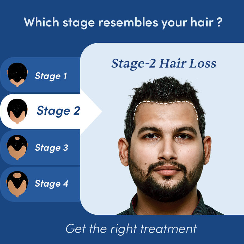 buy-stage-2-hair-regrowth-kit-for-dandruff-3m-man-matters